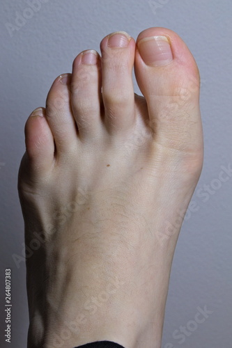 Close-up of foot with early stage of Hallux Valgus foot condition..