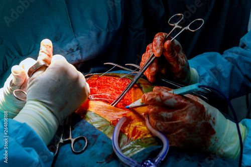 A scrub sewing after a doctor for use bypass coronary artery surgery.