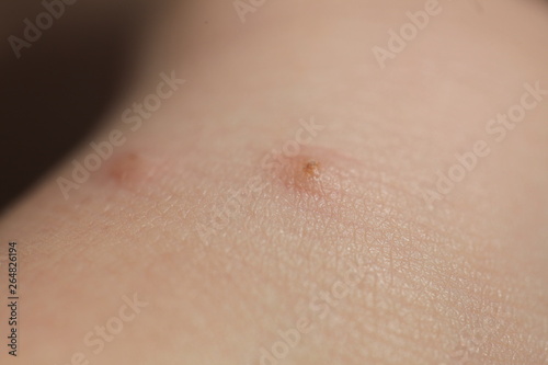 insect bites on skin child