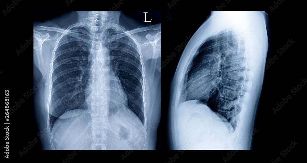 Comparison of Chest Xray PA and Lateral view or XRay Image Of Human