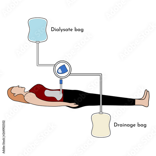 Continuous Ambulatory Peritoneal Dialysis (CAPD) , vector illustration