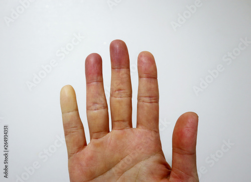 raynauds disease