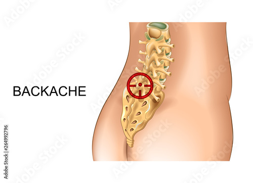 pain in the sacrum and lumbar vertebrae photo