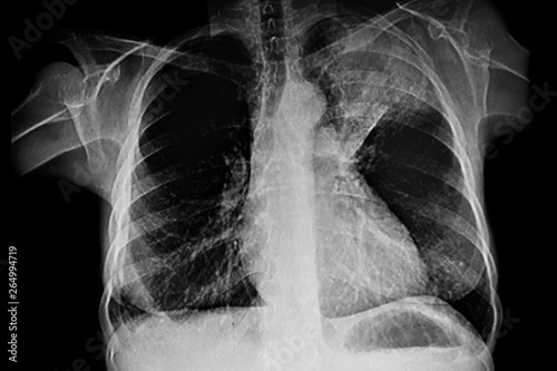 X - Ray of Left upper lung tumor photo