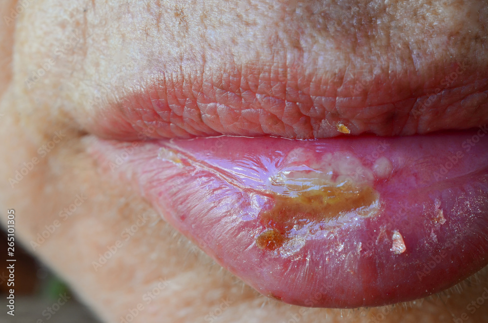 Obraz premium Macro shot of Herpes simplex labialis