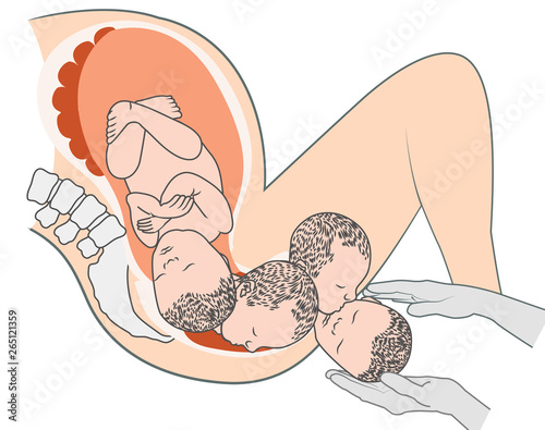 Baby Fetus in Pregnant Woman's belly medical illustration