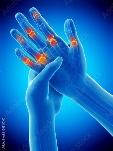 3d rendered medically accurate illustration of painful finger joints