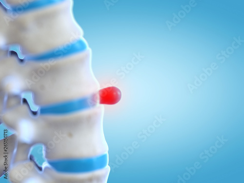 3d rendered medically accurate illustration of a disc prolapse photo
