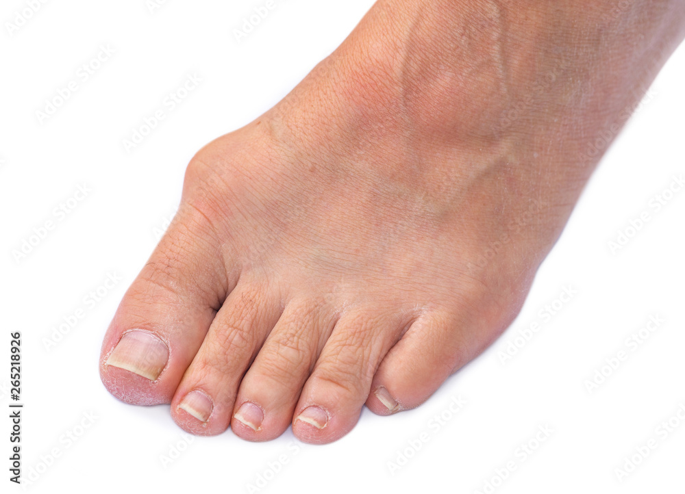 Foot of a woman with painful Hallux Valgus Foot of a woman with painful Hallux Valgus