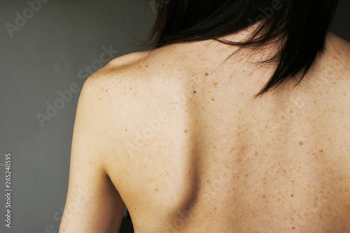 freckles and moles on the girl's back