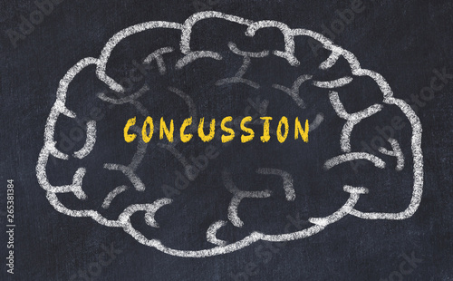 Chalk drawing of human brain with inscription concussion