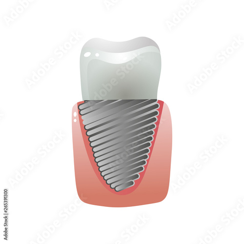 Metal steel ceramic white tooth implant, modern technology