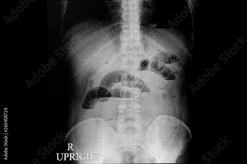  abdominal xray film of a patient with small bowel obstruction