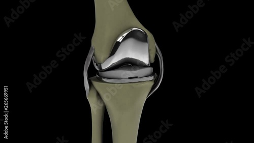 Human knee with knee replacement isolated on a black background 4k video 3d render