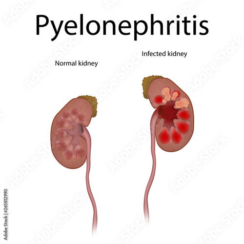 Pyelonephritis. Kidney infection. Infected, normal, healthy. Realistic anatomy vector illustration.