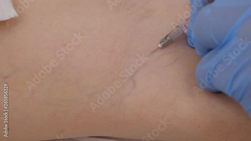 Vein disappears. Innovative method of varicose veins surgery, sclerotherapy procedure. Close-up shot of patient legs photo