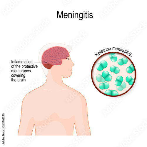 Meningitis and meningococcus (bacterium that caused acute inflammation of the protective membranes covering the brain)