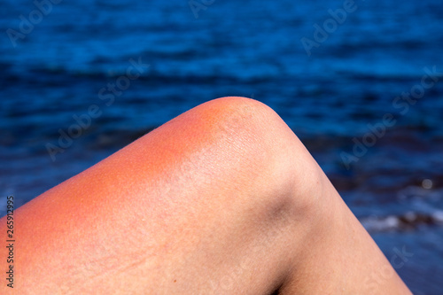 Woman leg with red sunburn skin on blue sea background. Sun burned skin redness and irritation.