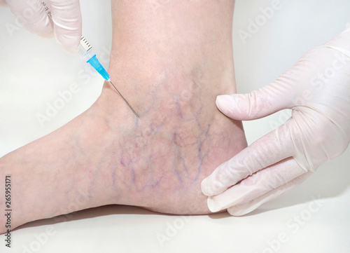 Spider veins on the womans legs  sclerotherapy treatment