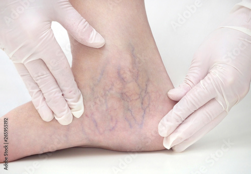 Spider veins on the womans legs, sclerotherapy treatment