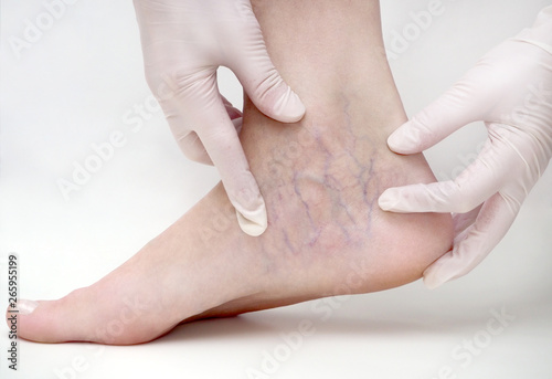 Spider veins on the womans legs, sclerotherapy treatment
