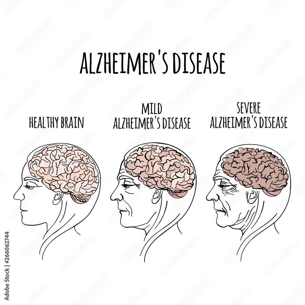 Alzheimers Memory Loss