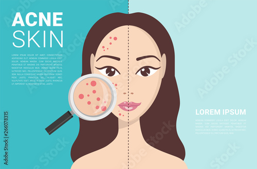 Acne, skin problems, stages of acne. Woman holding magnifying glass for looking cystic acne on her facial. Vector illustration about skin problem concept