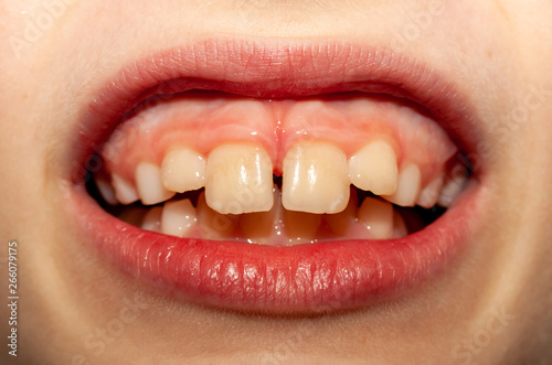 Caucasian European school boy showing his projecting upper front teeth photo