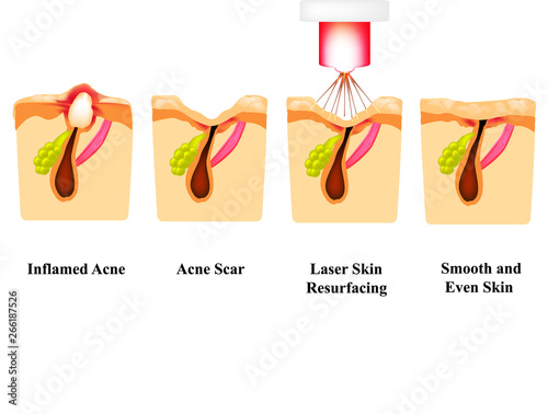 Inflamed acne on the skin. Inflamed pimple. Acne scar. Laser treatment. Laser polishing. The structure of the skin. Wrinkles. Infographics. Vector illustration on isolated background.