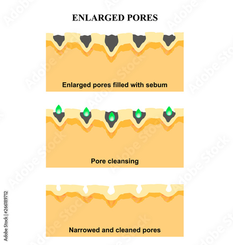 Enlarged pores. The structure of the skin. Wrinkles, acne scar. Cleansing and narrowing the pores. Infographics. Vector illustration on isolated background.