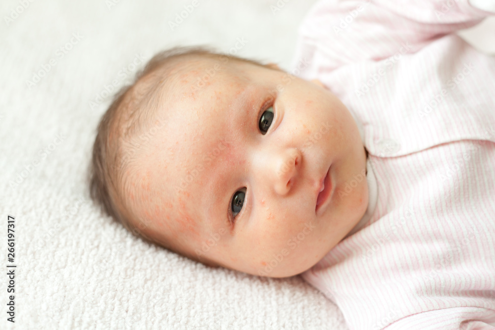 Portrait of a newborn baby close-up. On the face of the baby rash, acne Portrait of a newborn baby close-up. On the face of the baby rash, acne