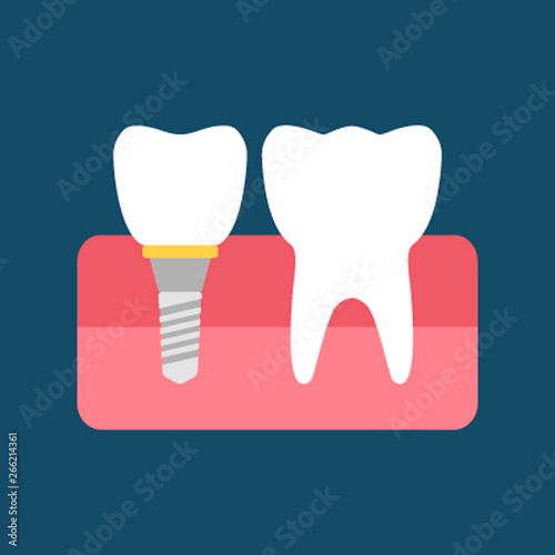 A dental implant and a normal tooth. Flat vector illustration isolated