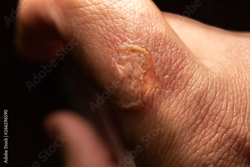 Fotografia Snake bite of index finger in detailed macro image