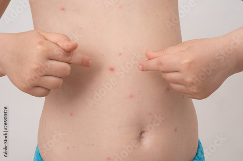 Baby with chicken pox rash. Varicella virus or Chickenpox bubble rash on child. Dermatology concept. Toddler shows blemishes on his body photo