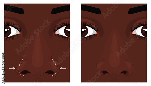 Vector illustration. Front view of a wide human nose before, after aesthetic plastic surgery - rhinoplasty (nose job). Close up view. For advertising, medical and beauty publications