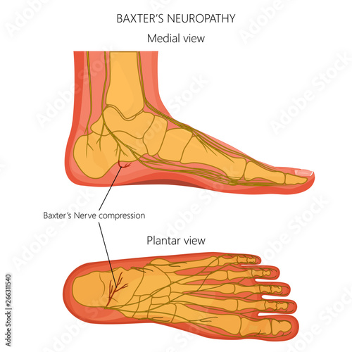 Vector illustration, diagram of the Baxter's neuropathy problem, inflammation of the inferior calcaneal nerve. Medial and plantar view of a human foot. photo