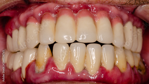 Canvas Print close up of a teeth with a severe, acute inflammation