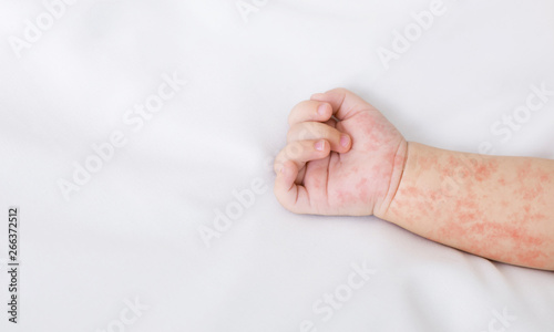 Hand of newborn baby with measles rash on white sheet photo