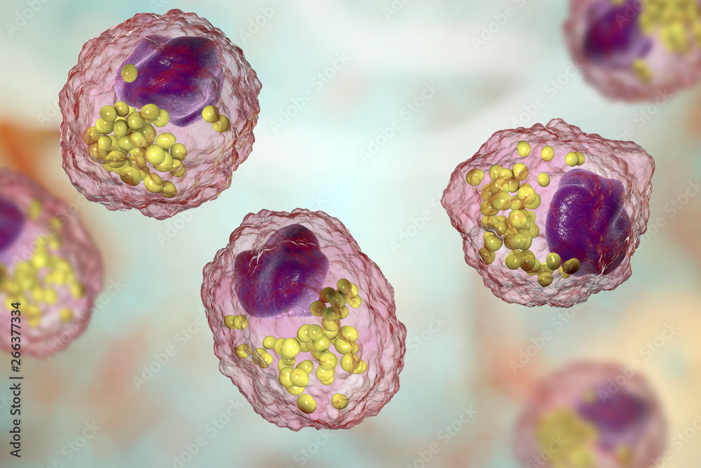 Foam cell, a macrophage cell with lipid droplets