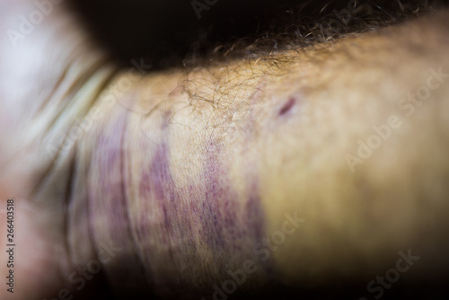 Bruise on man arm. Injection bruises. High contrast macro photography. Purple veins. photo