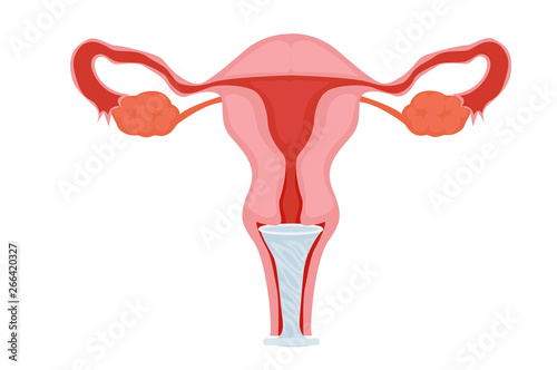 Female condom in the uterus