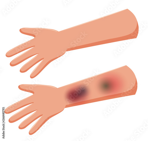Set of bruising on hands