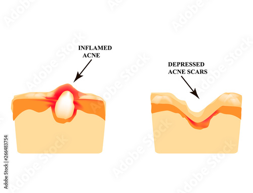 Inflamed acne on the skin. Inflamed pimple. The structure of the skin. Acne scar. Infographics. Vector illustration on isolated background.