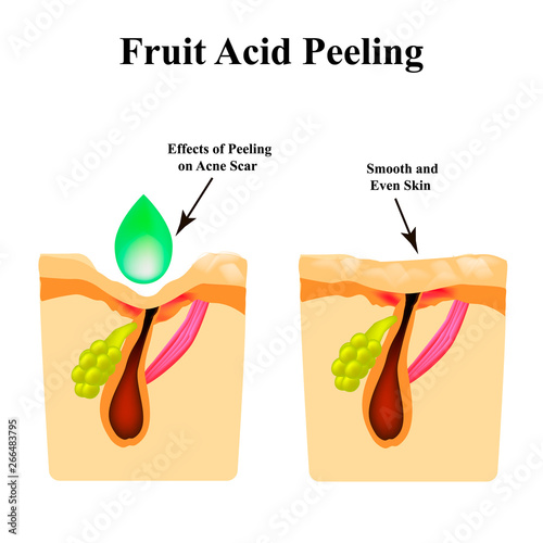Inflamed acne on the skin. Inflamed pimple. Acne scar. Acid peeling treatment. The structure of the skin. Wrinkles. Infographics. Vector illustration on isolated background.