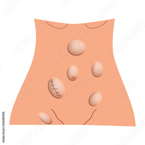 Types of hernia. Epigastric, Lateral, Umbilical, Inguinal, femoral, incisional hernia. intestinal hernia. Infographics. Vector illustration on isolated background.