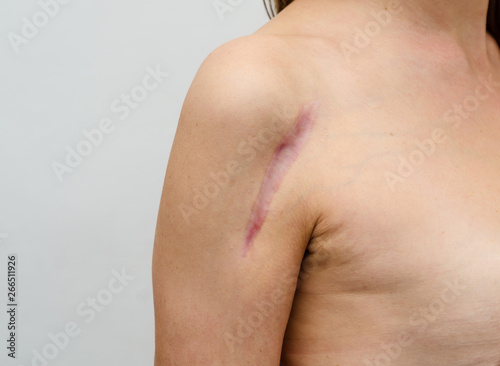Fototapeta Close up of female shoulder with a scar after install a metal plate  bone fracture surgically