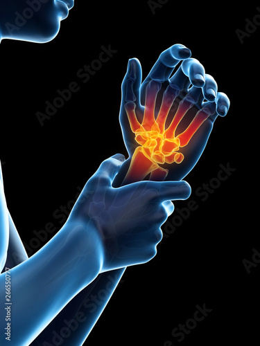 Fototapeta Naklejka Na Ścianę i Meble -  3d rendered medically accurate illustration of painful wrist