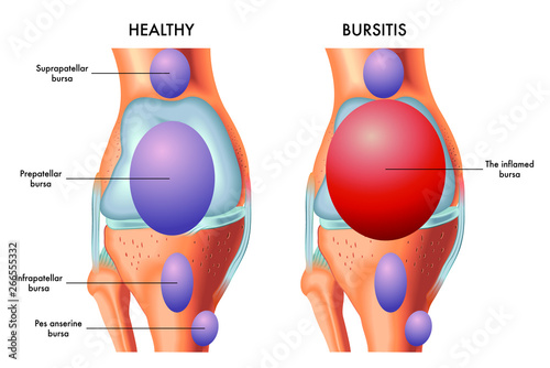 A medical illustration of a knee with an inflamed prepatellar bursa in comparison with a healthy knee.