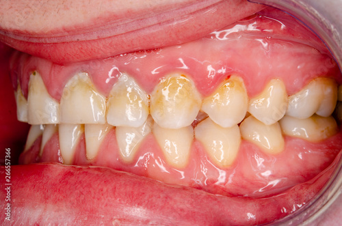 gingivitis and dental plaque closeup of a juvenile dentitiion