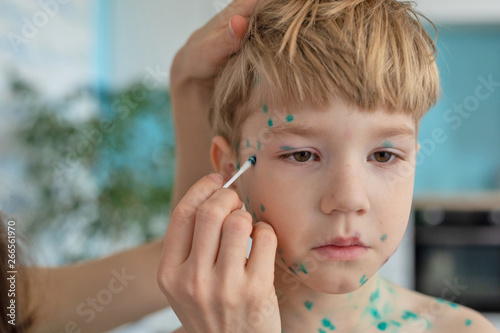 Portrait of sick little boy. Varicella virus or Chickenpox bubble rash on child